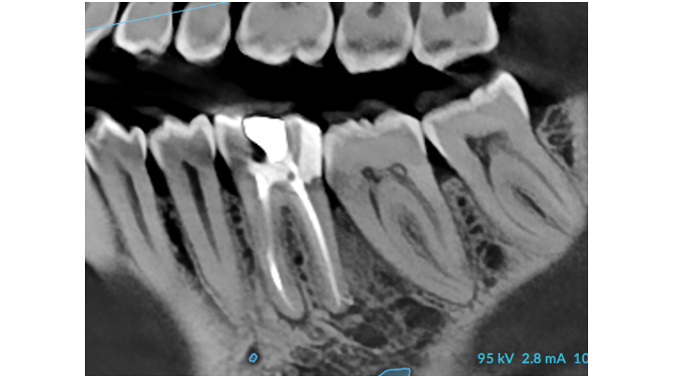 After osseous surgery with bone grafting