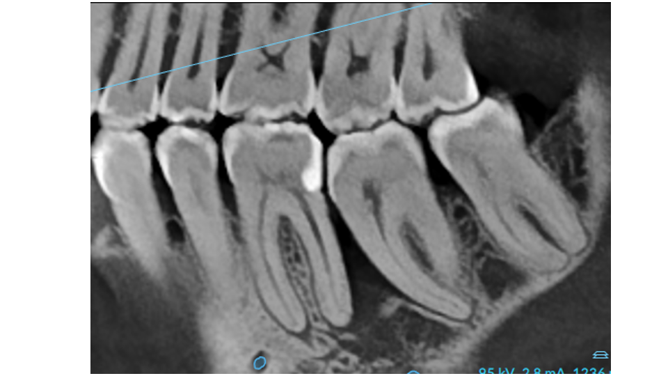 Before osseous surgery with bone grafting