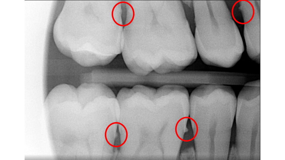 Radiograph showing calculus deposits on teeth