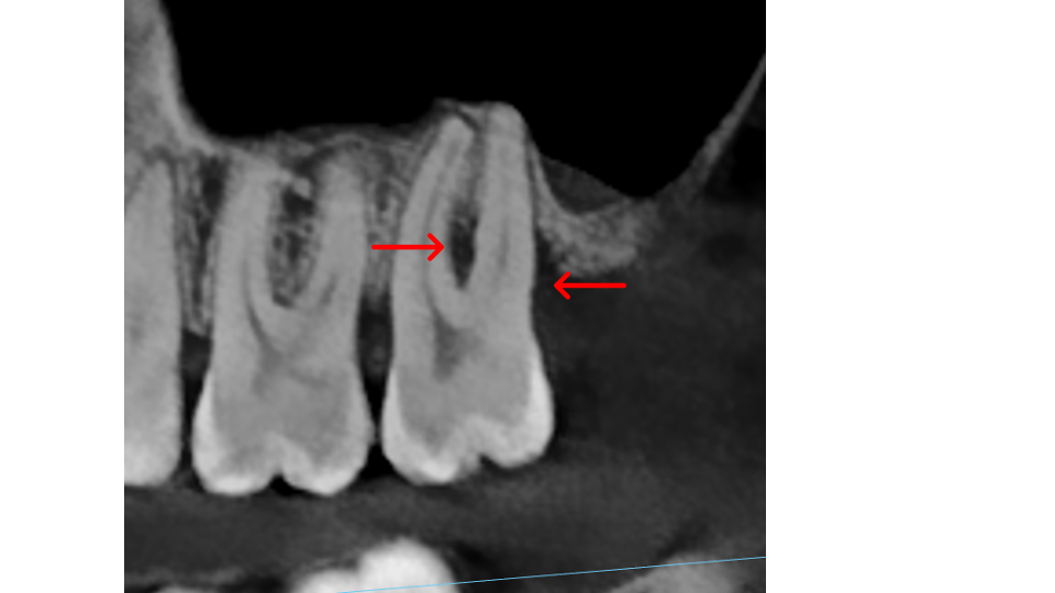 Furcation bone loss stage 1