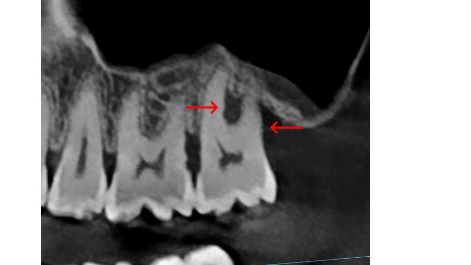 Furcation bone loss stage 2