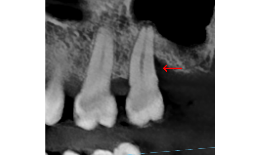 Furcation bone loss stage 3