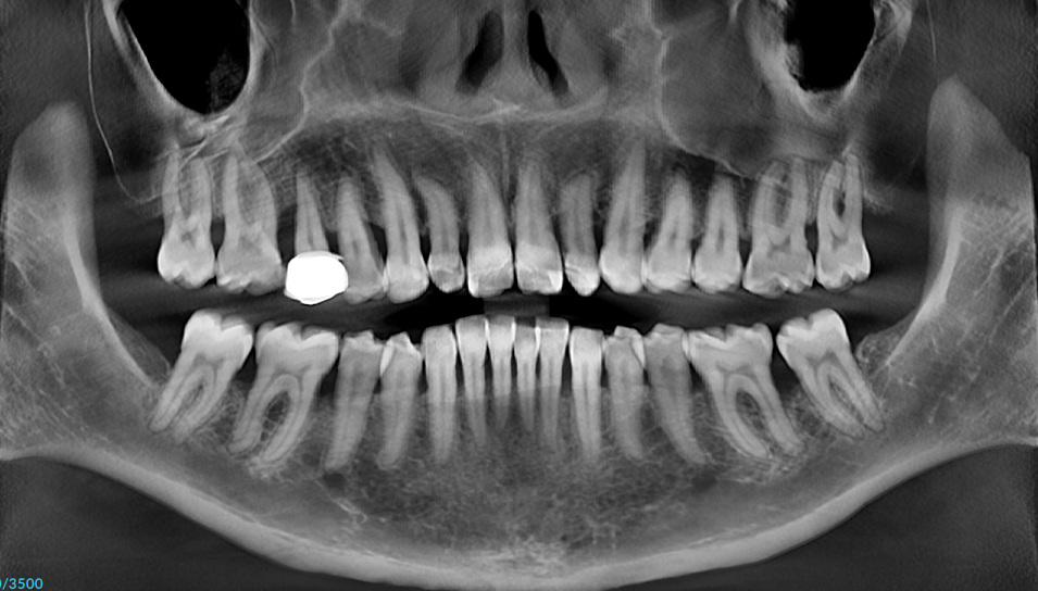 Radiograph showing generalized moderate to severe bone loss
