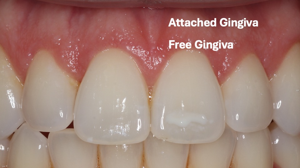 Healthy gum tissue showing free gingiva and attached gingiva