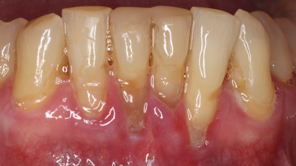 Comparison showing healthy thick tissue versus inflamed areas lacking protective tissue