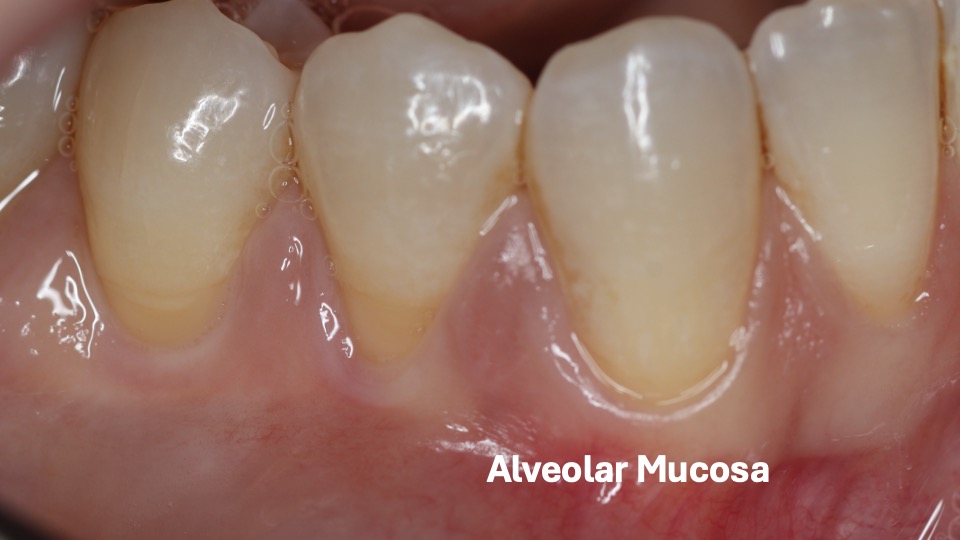 Patient lacking keratinized tissue with only alveolar mucosa