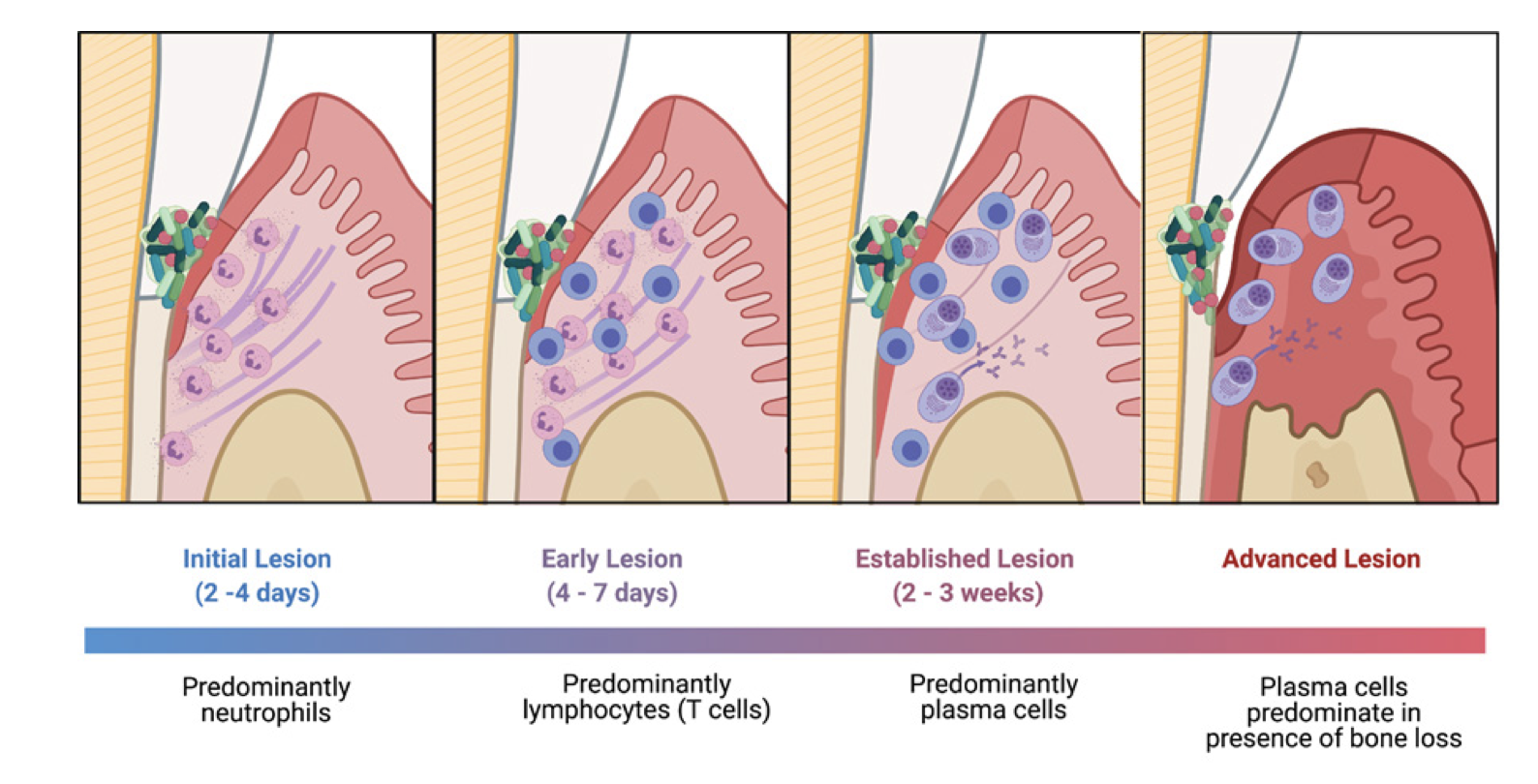 Page and Schroeder model of periodontal disease progression