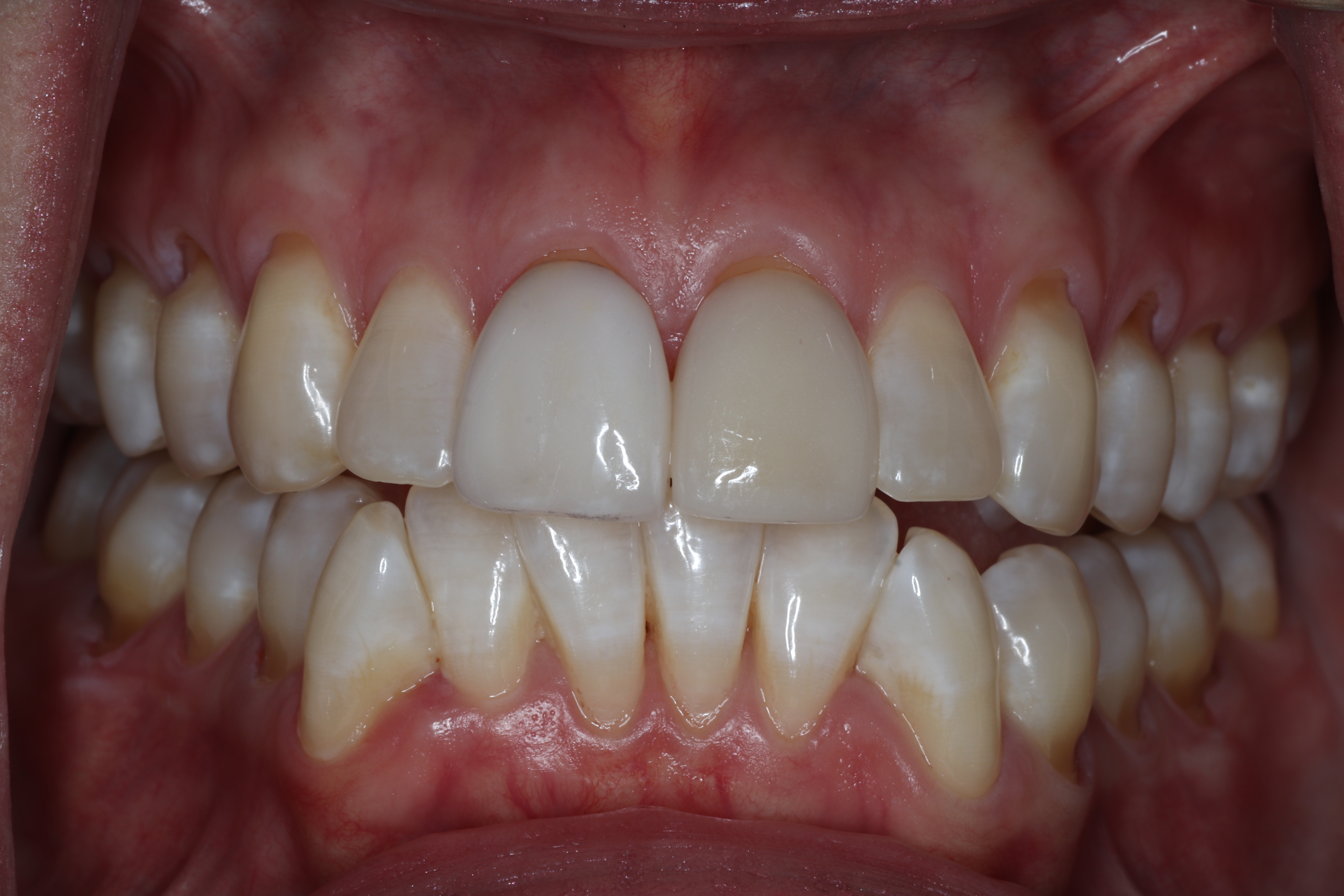 Recession from aggressive tooth brushing