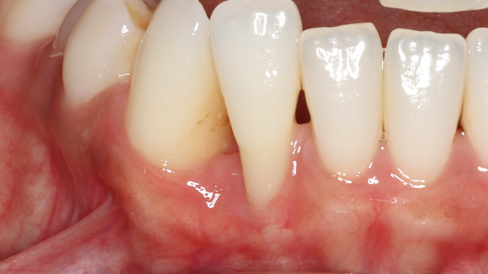 Clinical photo showing recession from periodontal disease
