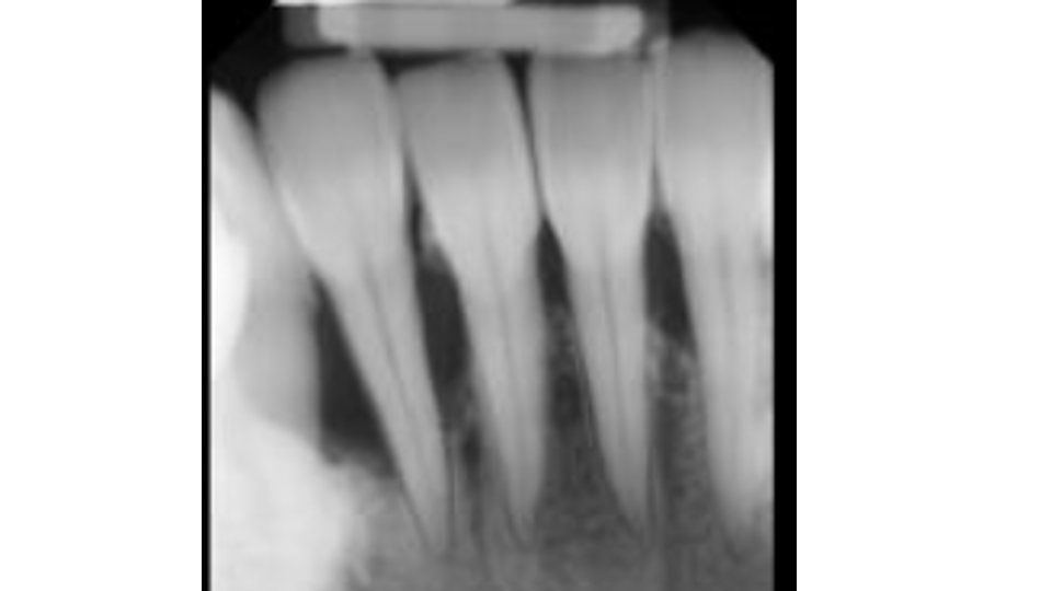 Radiograph showing bone loss