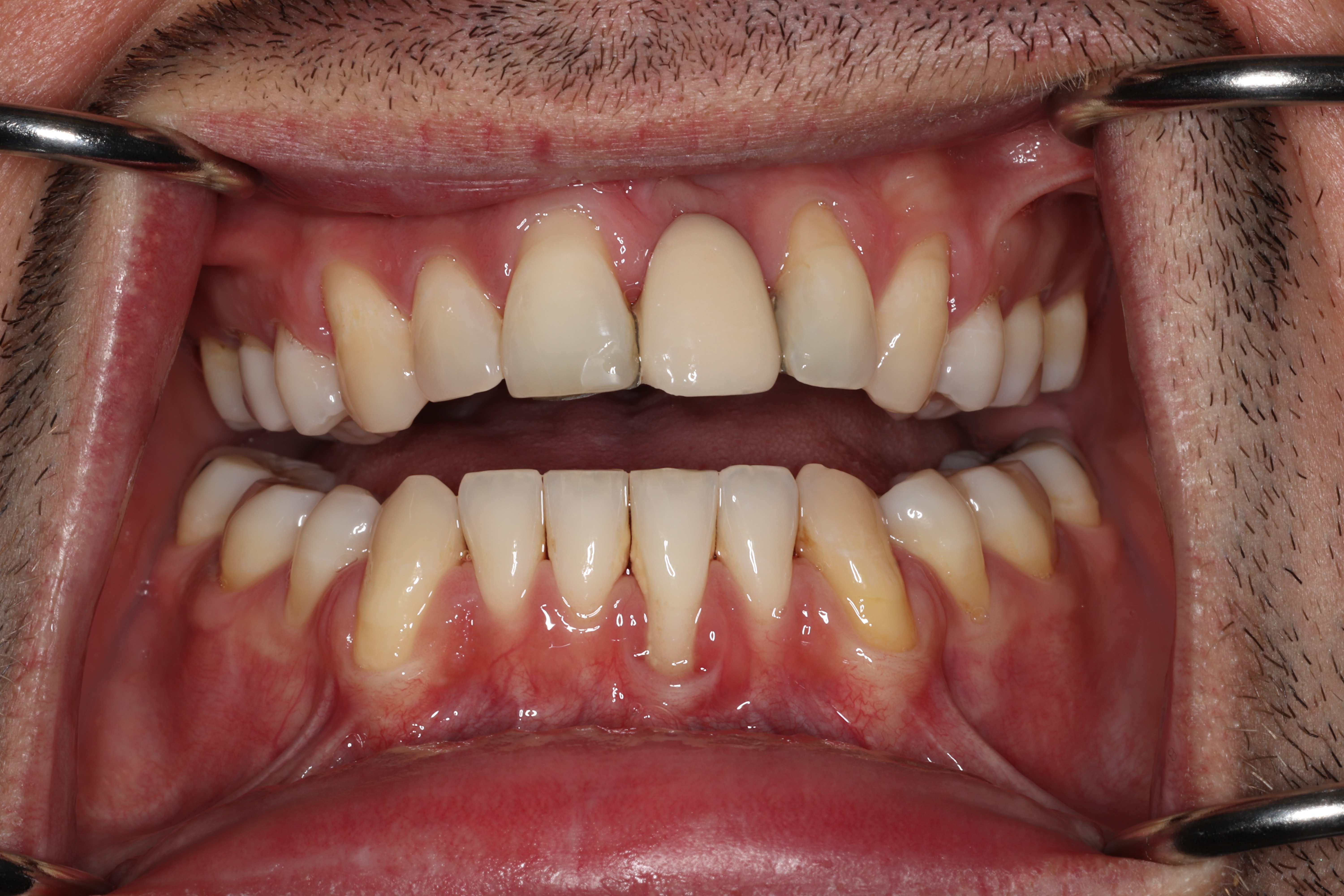 Recession due to tooth position