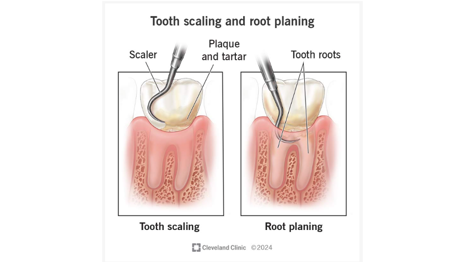 Scaling and root planing illustration