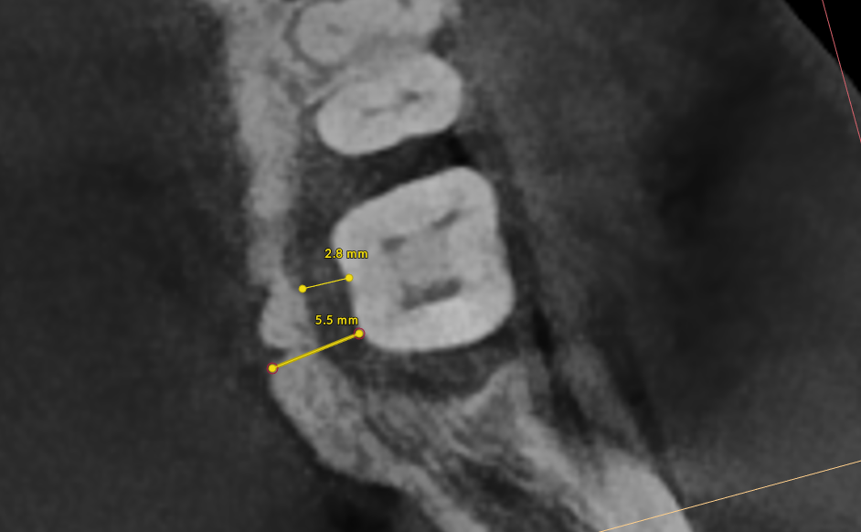 Thick bone radiograph showing initial bone loss