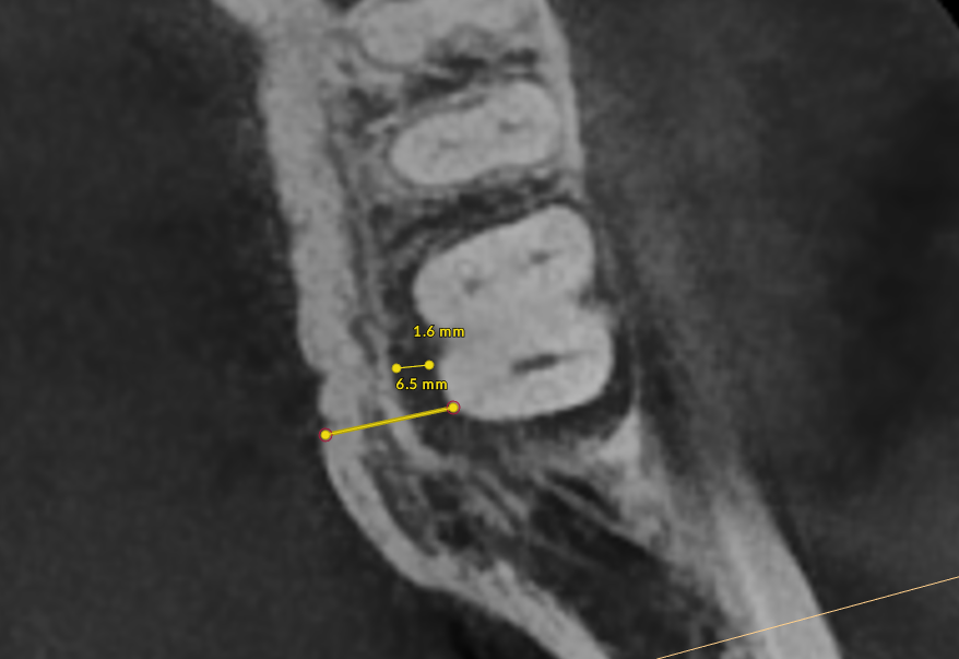 Thick bone radiograph showing progression of bone loss