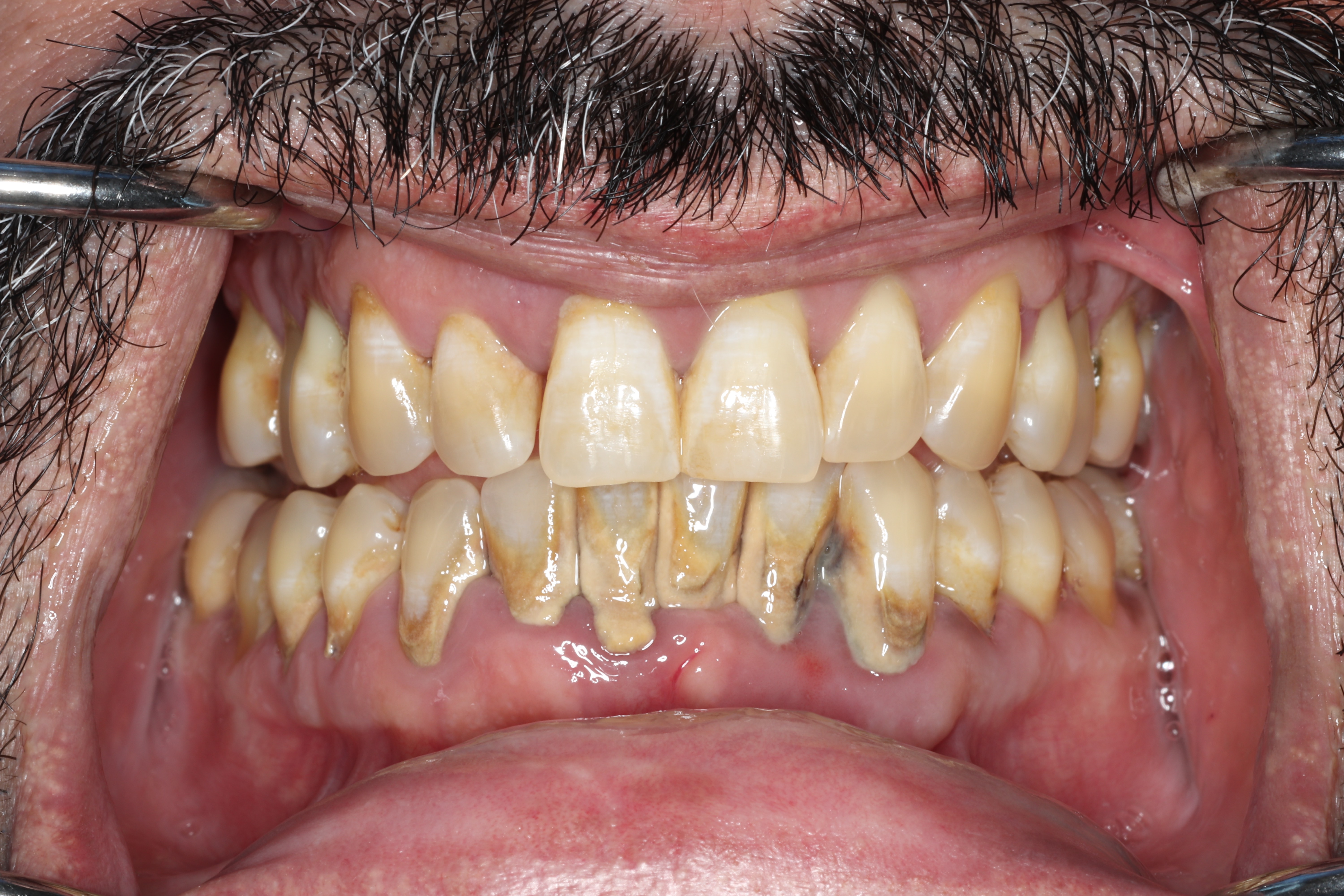 Before treatment