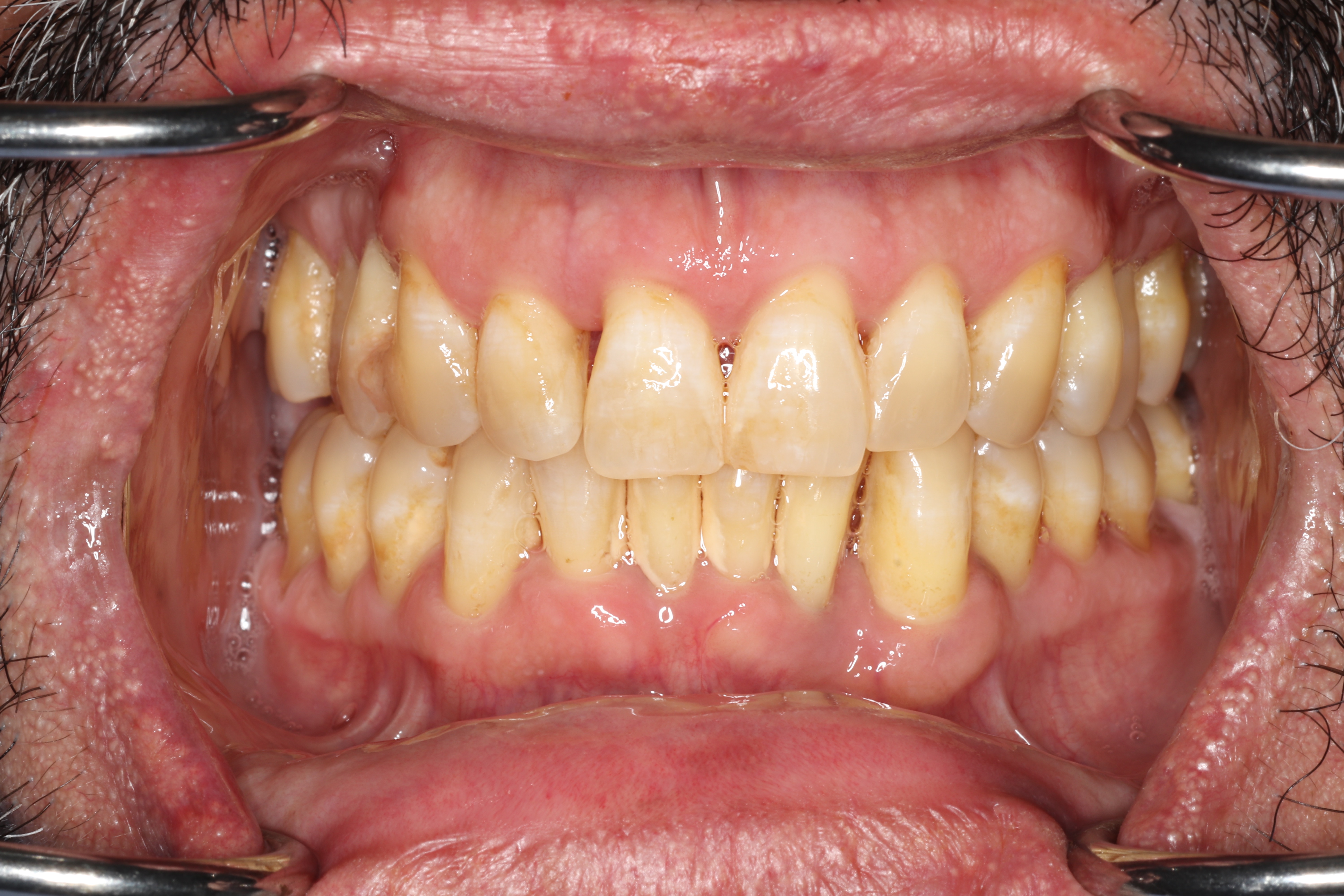 After scaling and root planing and osseous surgery